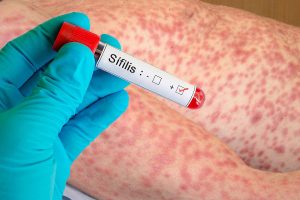 test sífilis síntomas sífilis