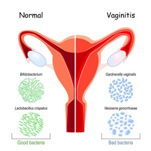 Imagen que compara un tejido vaginal saludable con uno afectado por vaginitis