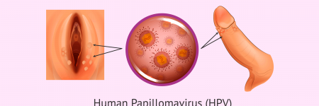 symptoms of papilloma